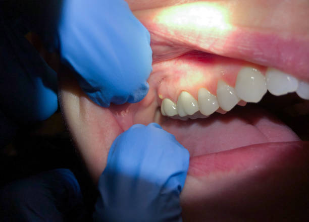 Best Emergency Wisdom Teeth Removal in Stonewall, LA